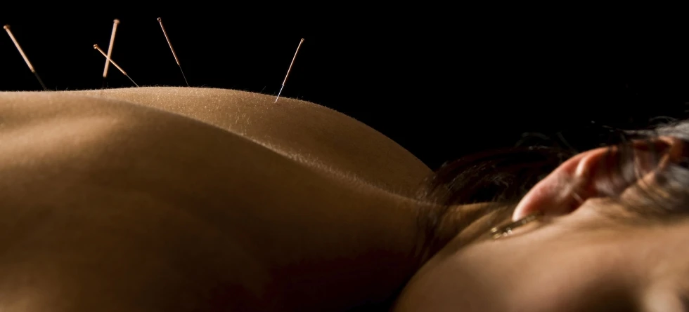 Acupuncture